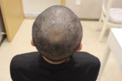 -大麦微针植发丨全国连锁