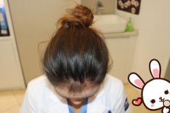 点击看大图 -大麦微针植发丨全国连锁