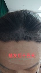 体验前-大麦微针植发丨全国连锁