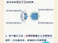 -黑马眼科·近视手术