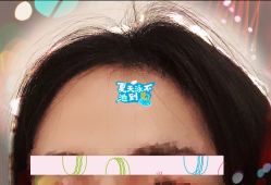 -大麦微针植发全国连锁