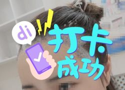 -大麦微针植发全国连锁