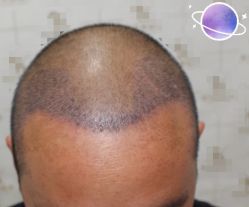 -大麦微针植发丨全国连锁