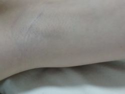体验后-嘉和医学脱毛中心