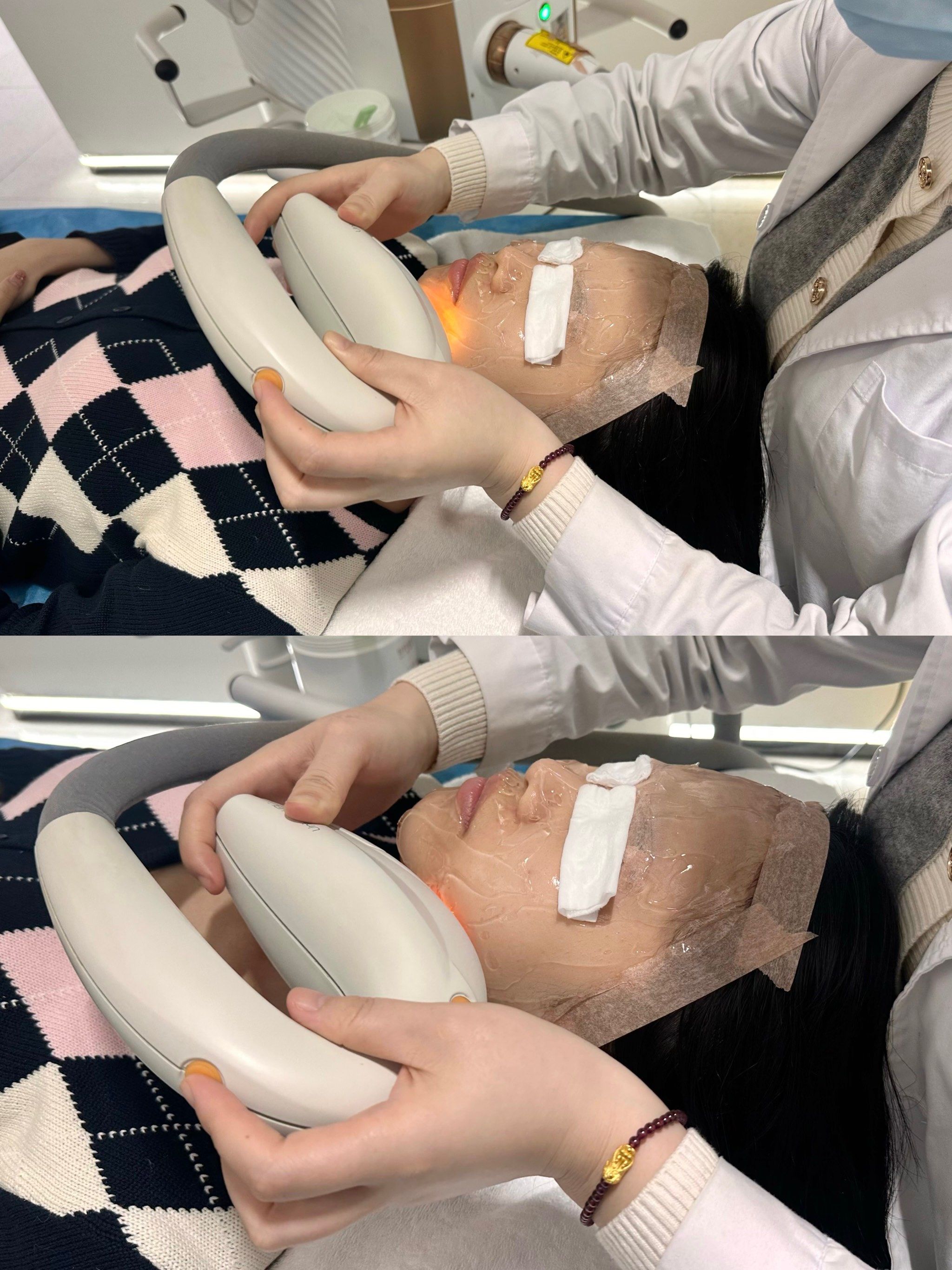 试一下坚持做光子嫩肤3个月会怎么样?