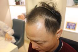 点击看大图 -大麦微针植发丨全国连锁