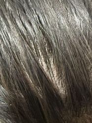 -碧莲盛·不剃发植发