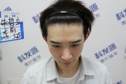 点击看大图 -大麦微针植发丨全国连锁