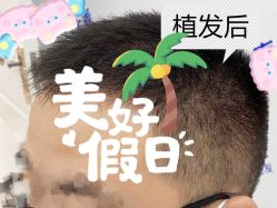 -大麦微针植发全国连锁