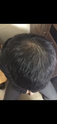 -大麦微针植发全国连锁