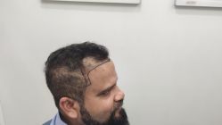 -大麦微针植发全国连锁