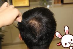 点击看大图 -大麦微针植发丨全国连锁