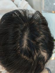 -碧莲盛·不剃发植发
