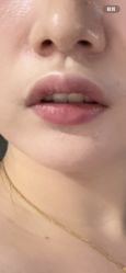 体验后-佛山艺美医疗美容·整形·美肤·塑形