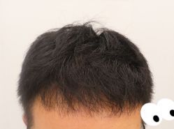 -大麦微针植发全国连锁