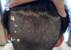 -大麦微针植发全国连锁