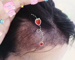 -大麦微针植发全国连锁