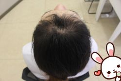 -大麦微针植发丨全国连锁