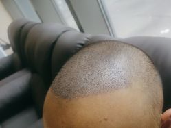 -碧莲盛·不剃发植发