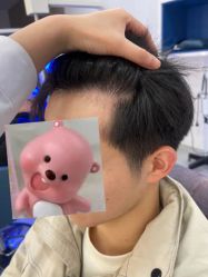 体验后-大麦微针植发全国连锁