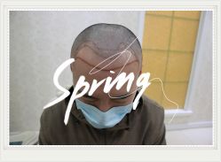 -大麦微针植发全国连锁