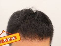 -大麦微针植发全国连锁