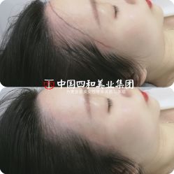 点击看大图 -西施无菌半永久纹绣眉眼影唇轻增发纹发际线