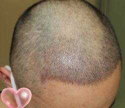 -大麦微针植发丨全国连锁