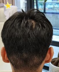 -大麦微针植发丨全国连锁