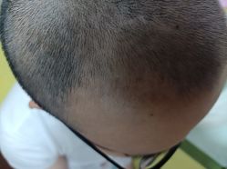 -大麦微针植发丨全国连锁