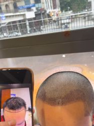 -碧莲盛·不剃发植发