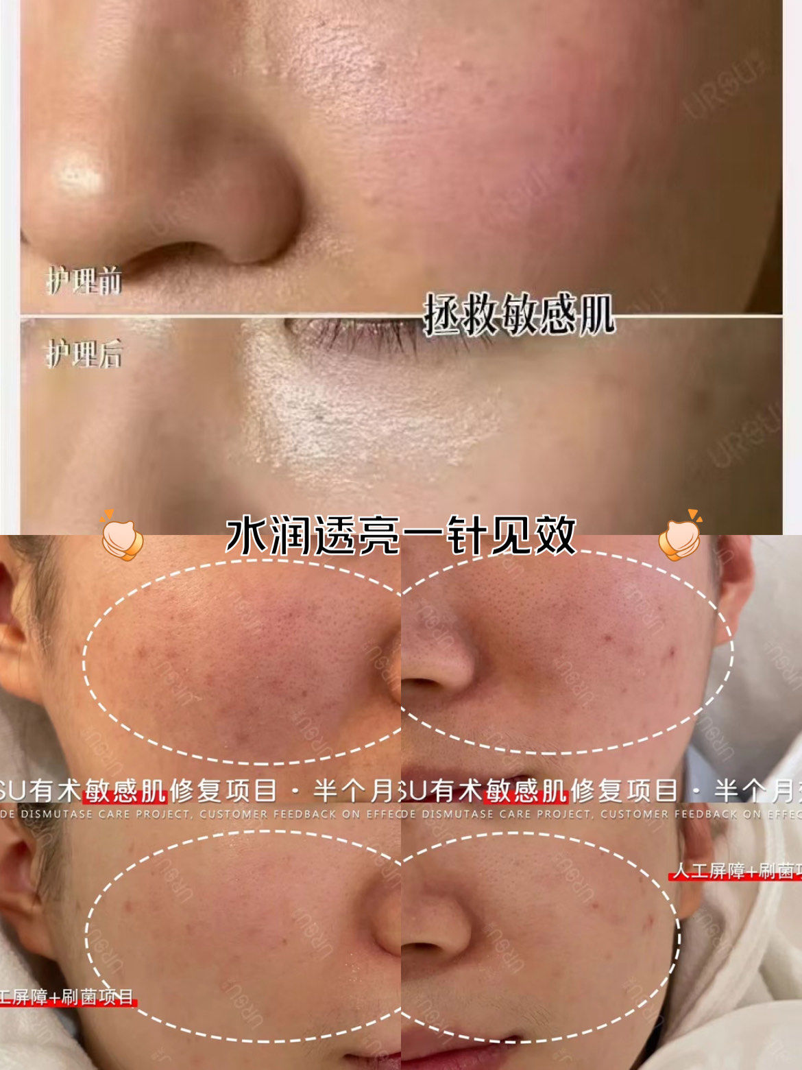 皮肤屏障受损修复