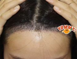 -大麦微针植发全国连锁