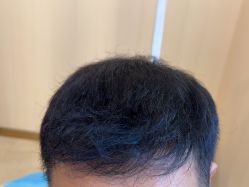 -碧莲盛·不剃发植发