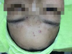 -苗医生草本科技祛痘