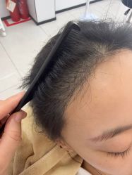-大麦微针植发丨全国连锁