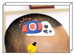 -大麦微针植发全国连锁