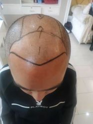 -大麦微针植发丨全国连锁