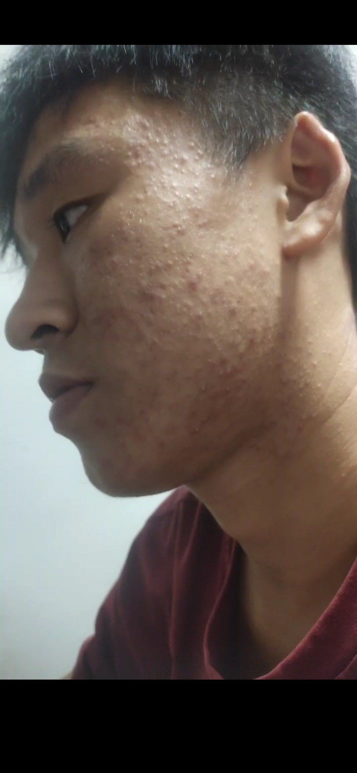 满脸的闭口粉刺再也不担心了