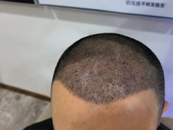 -碧莲盛·不剃发植发