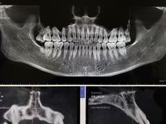X光片-Dr.Z dental仁康种植矫正中心