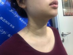 体验前-郡艺医疗美容·微整·眼鼻吸脂