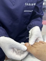 -德哥灰指甲脚气甲沟炎跖疣护理
