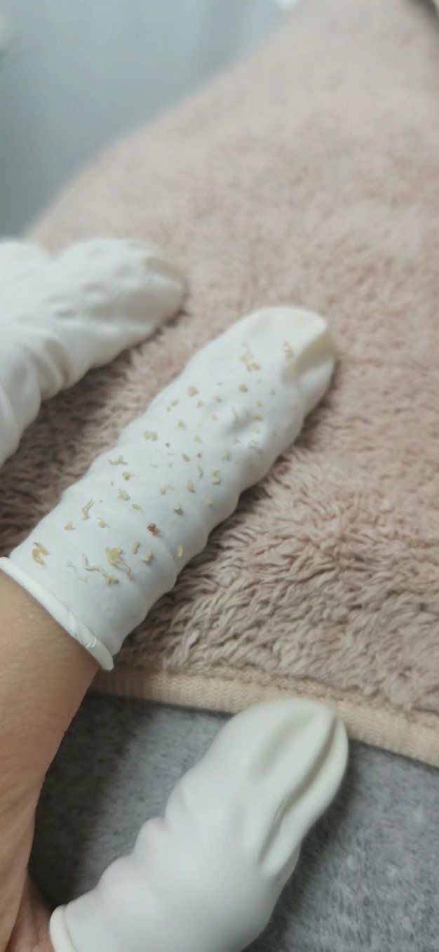 来到我们店里清出了一堆粉刺痘痘.