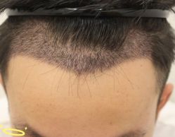 -大麦微针植发丨全国连锁