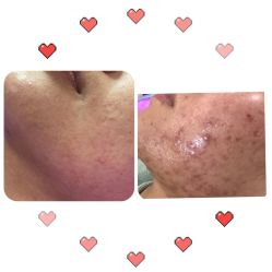 -蕾特恩祛痘•皮肤管理