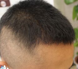 -大麦微针植发丨全国连锁