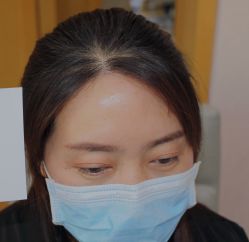 体验后-大麦微针植发全国连锁