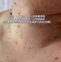-瑶芳清颜草本祛痘
