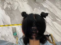 体验后-熙朵美学植发连锁